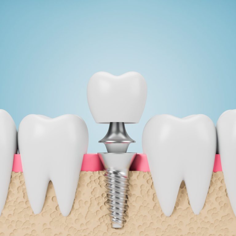 Implantat